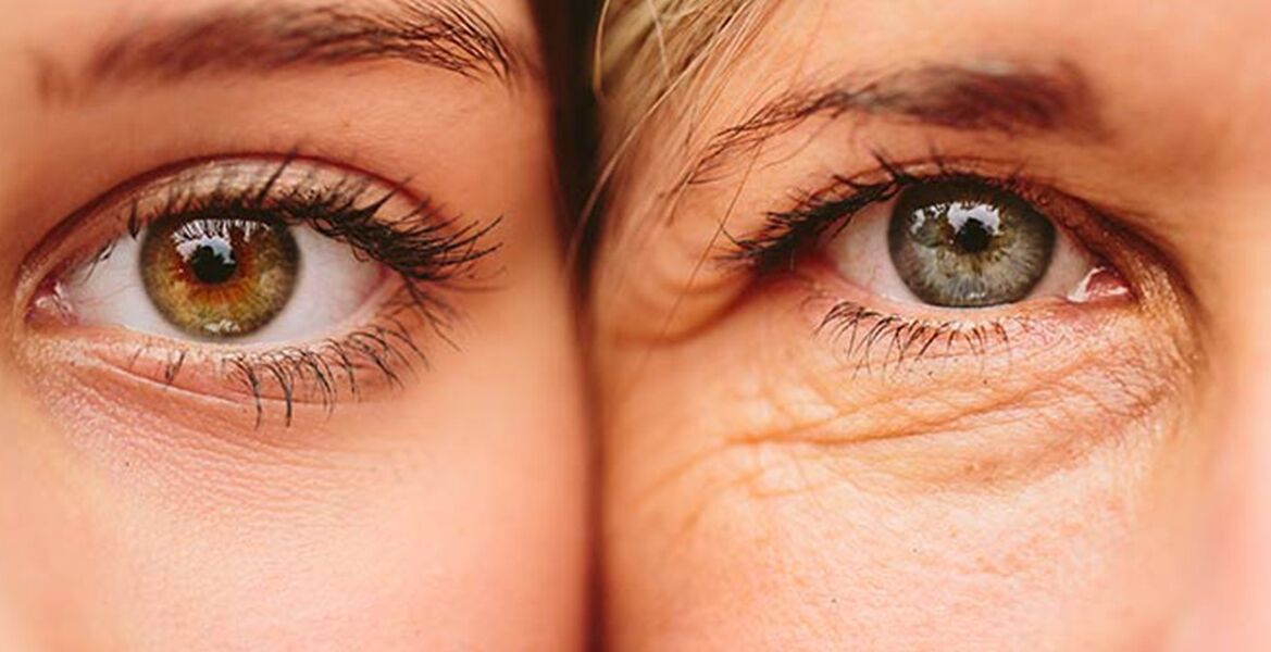 Zunanji znaki staranja kože okoli oči pri dveh ženskah različnih starosti