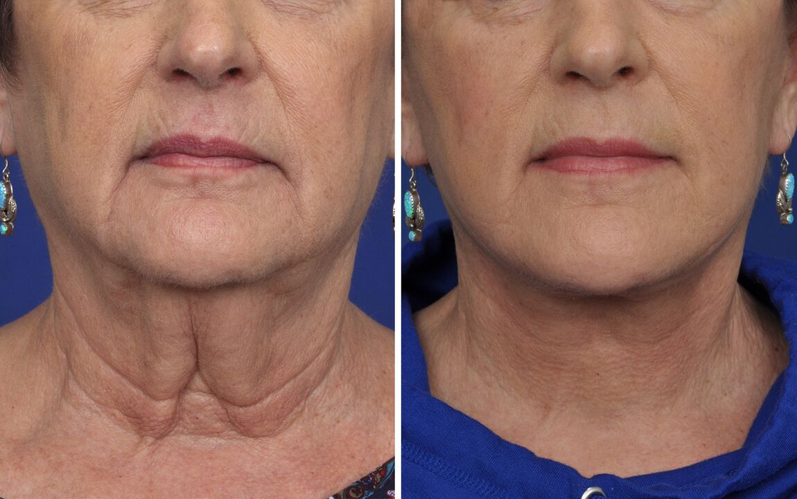pred in po postopkih pomlajevanja kože
