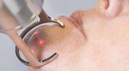 Potek postopka za delno lasersko pomlajevanje kože obraza