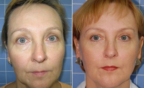 Pred in po delnem laserskem pomlajevanju obraza