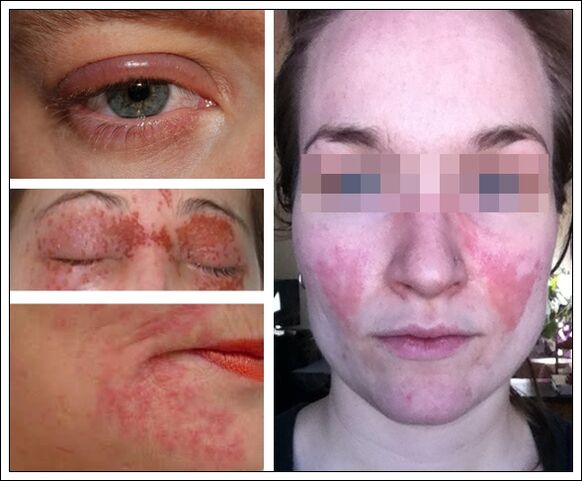 alergija na maske proti staranju