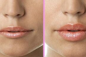 pred in po postopku obnove ustnic
